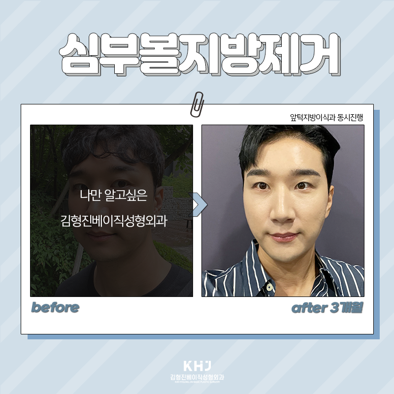 심부볼지방제거부작용 걱정하지 마세요! 관련 이미지 6