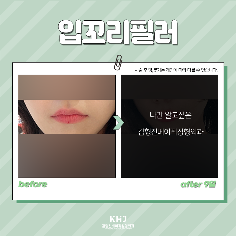 입꼬리필러모양 자연스럽게 원하신다면 관련 이미지 5