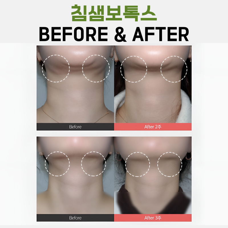 자연스럽게 또렷해 진 턱 선 만들어 준 침샘보톡스효과 관련 이미지 6