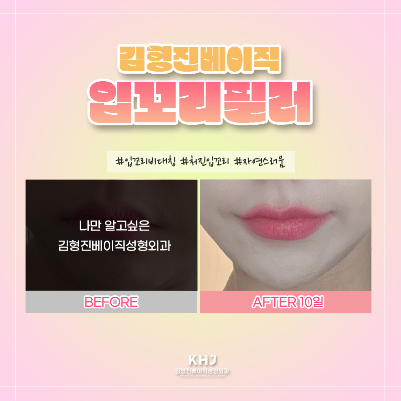 입꼬리필러전후 궁금하셨다면? 관련 이미지 6