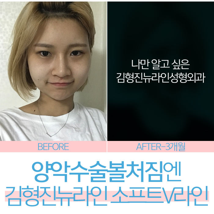 양악수술후볼처짐 두번 다신 없어야 해요 관련 이미지 1