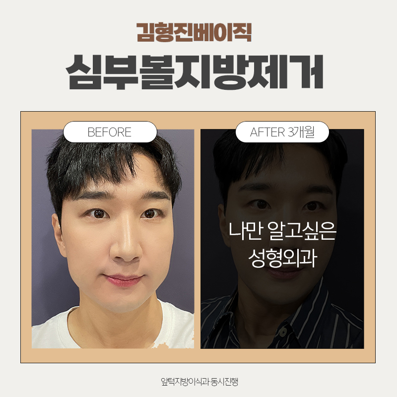 심부볼리프팅의 핵심, 이것 밖엔 방법이 없습니다! 관련 이미지 7