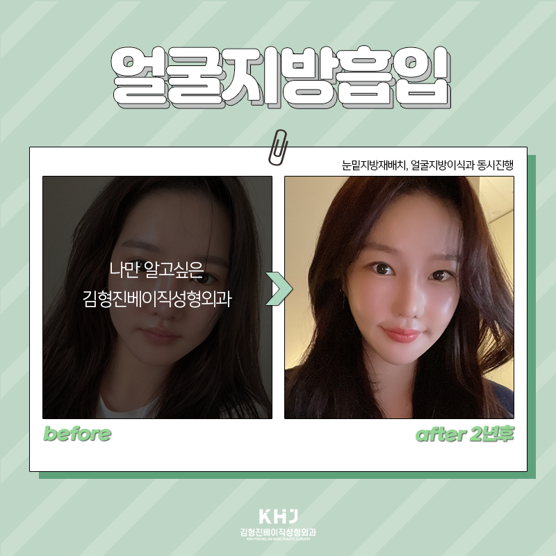 얼굴지방흡입부작용 걱정 되신다면 관련 이미지 6