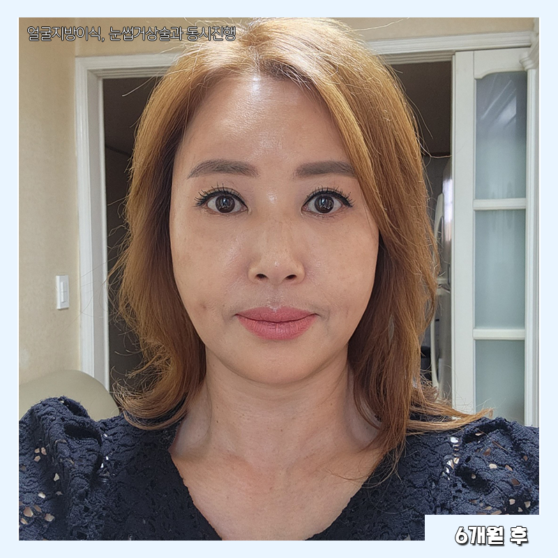 미니하안검효과 이렇게나 좋다구요! 관련 이미지 5