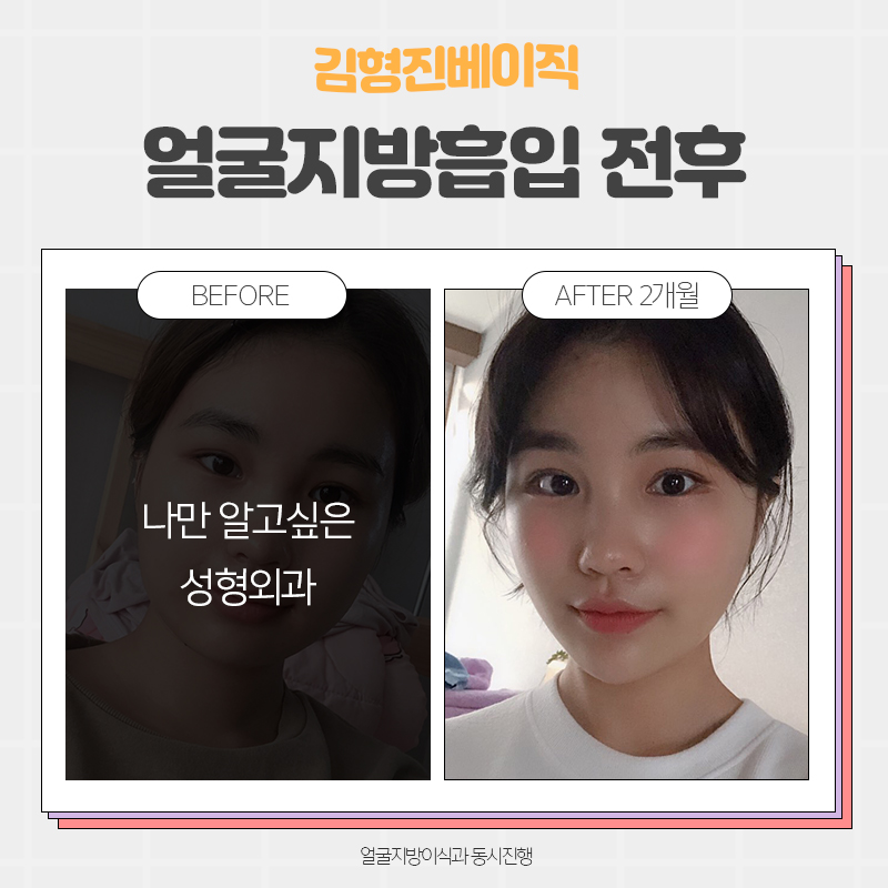 얼굴지흡후기 좋은 이유 궁금하시죠? 관련 이미지 3