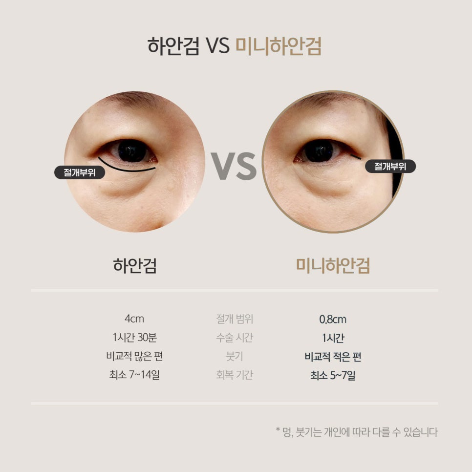 미니하안검은 반드시 중년눈성형잘하는곳에서 관련 이미지 5