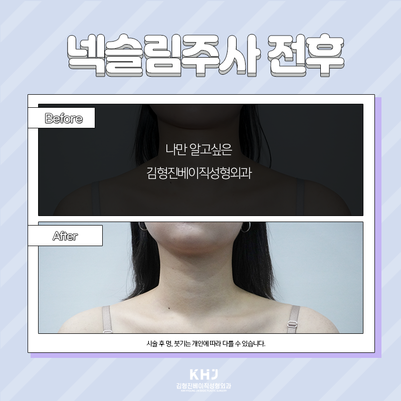 넥슬림주사전후 당연히 보여드려야죠! 관련 이미지 5