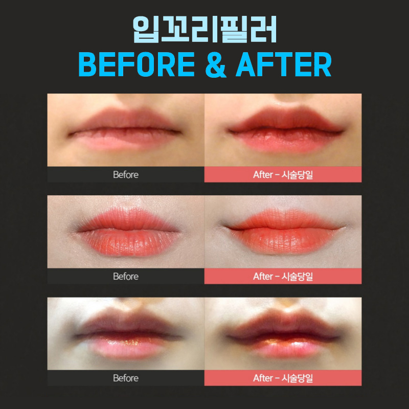 처진입꼬리 고민, 입꼬리필러로 자연스럽게 해결해요 관련 이미지 5