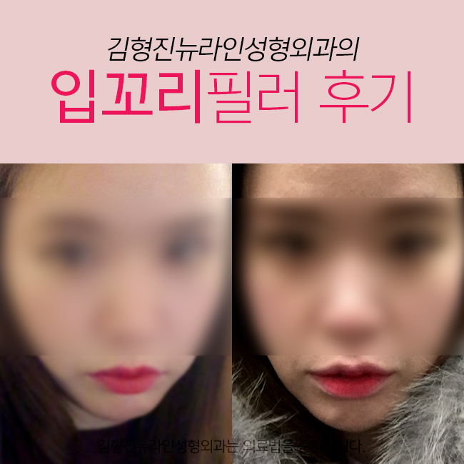 입꼬리필러후기 이정도는 되야지 관련 이미지 2