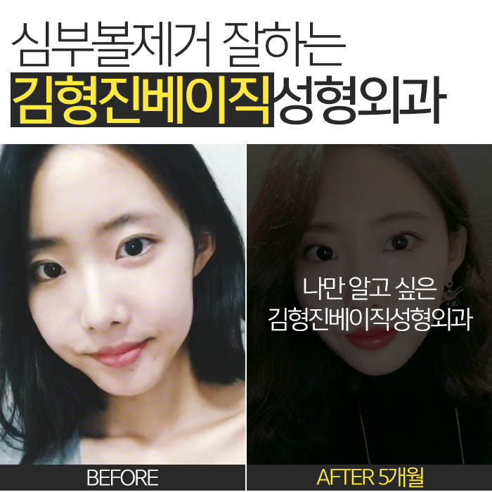 불독살 제거는 이 방법 뿐★ 관련 이미지 7