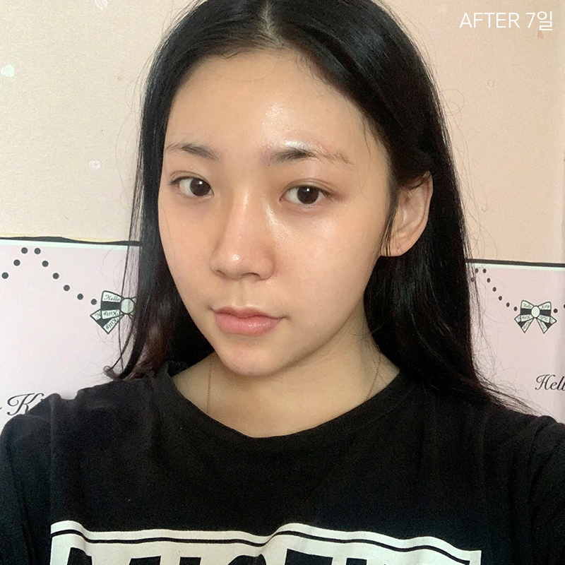 심부볼제거잘하는곳은? 바로 김형진베이직이죠! 관련 이미지 3