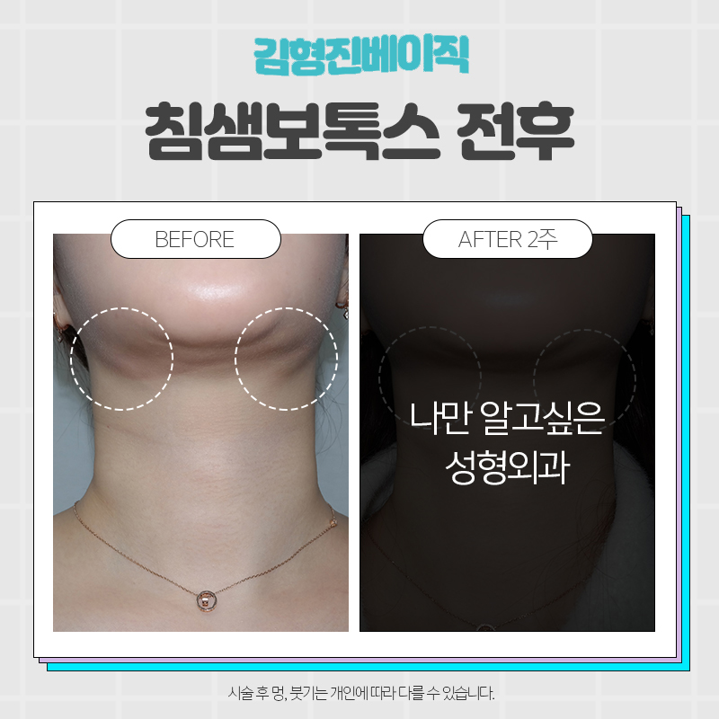 수많은 침샘보톡스후기가 증명해주는 김형진베이직 관련 이미지 5