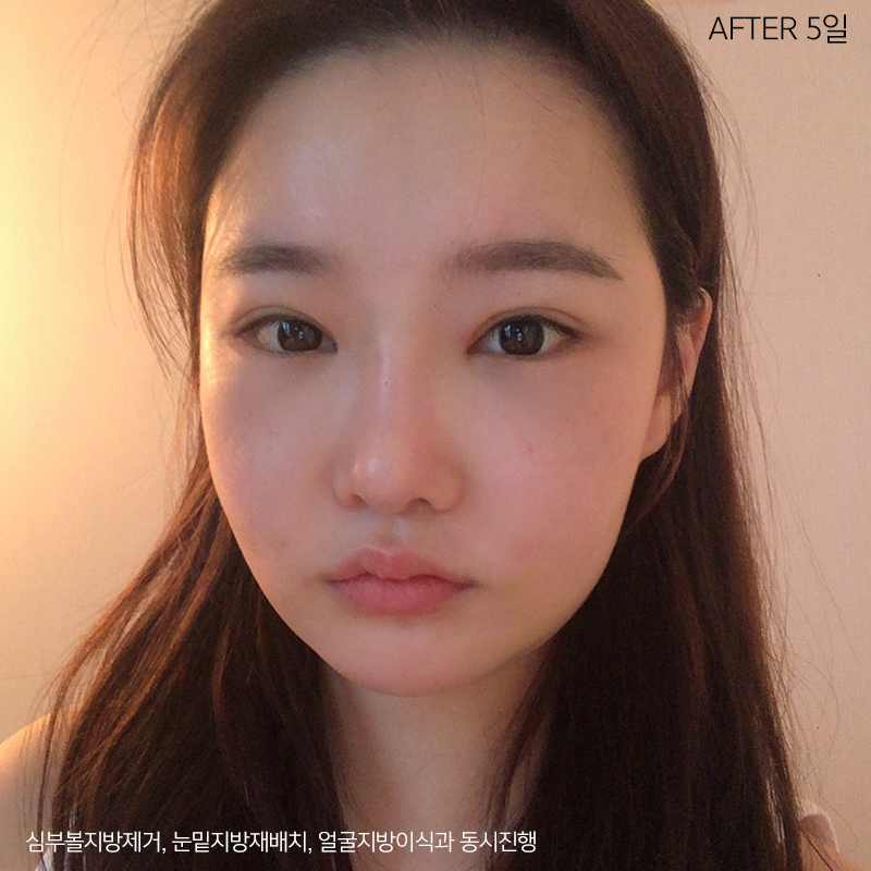 이중턱제거효과 아직 모르세요? 관련 이미지 3