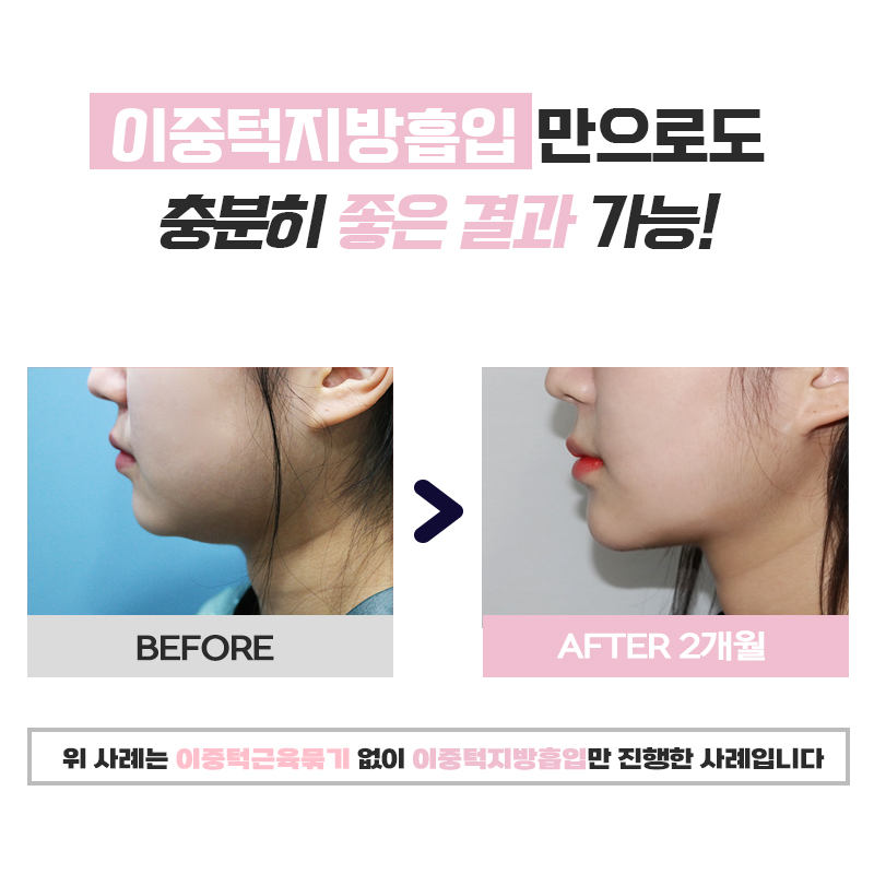 얼굴지방없애는법 김형진베이직에서 알려드려요 관련 이미지 7