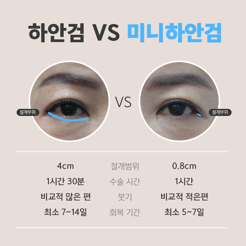 눈밑처짐수술로 나이 들어 보이는 노안 이미지 탈출했어요! 관련 이미지 4