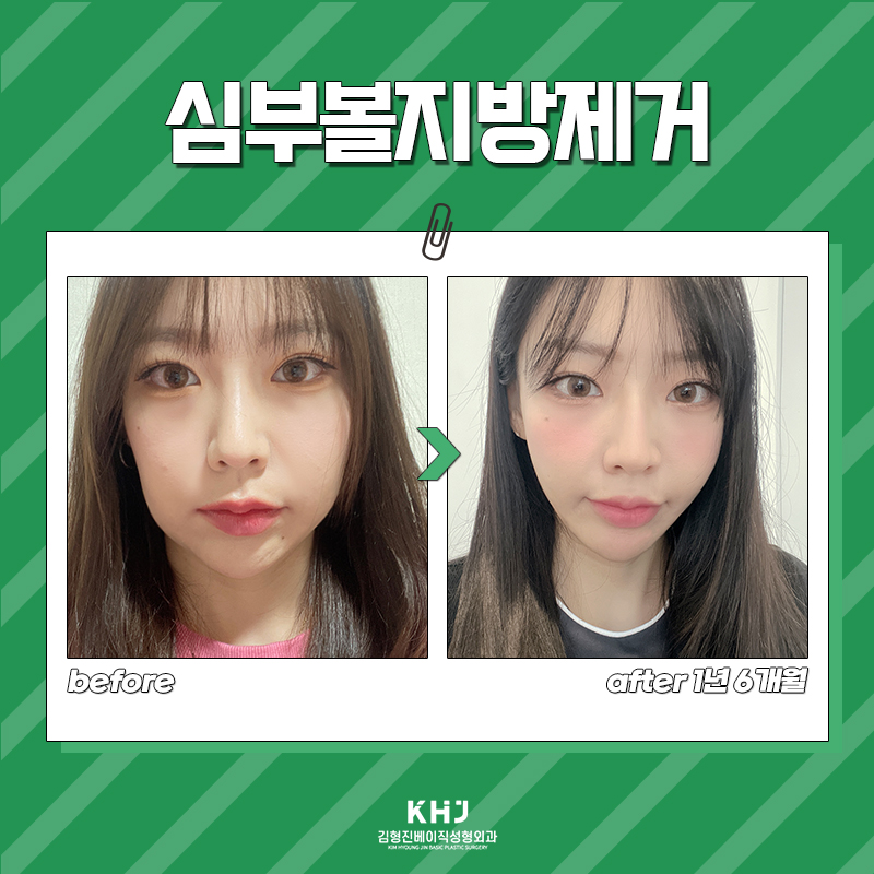 처진 볼살 정리하는 비밀, 심부볼지방제거술로 해결해요! 관련 이미지 6