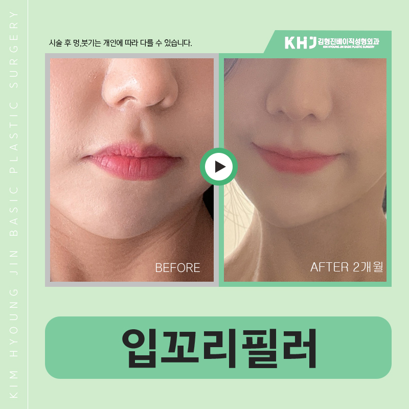 입꼬리올리는법 전후 차이 대박이에요 관련 이미지 6