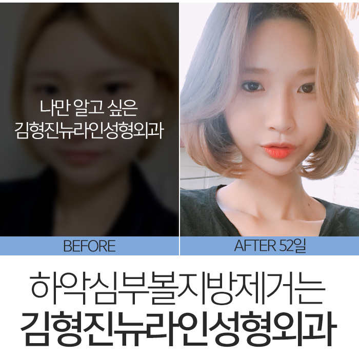 하악심부볼지방제거 보면 놀라요 관련 이미지 7