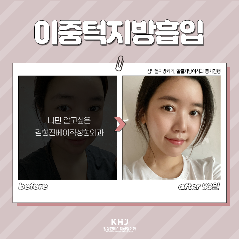 턱살빼는법 어렵지 않아요! 관련 이미지 6