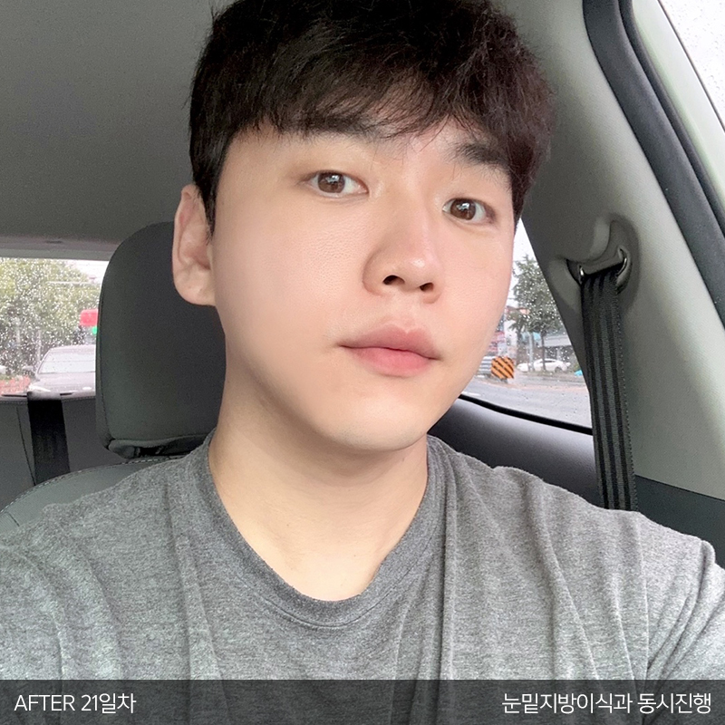 눈밑지방재배치수술효과 모르시는분! 관련 이미지 3