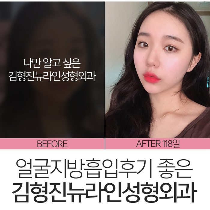 얼굴지방흡입후기 완벽 변신! 관련 이미지 2