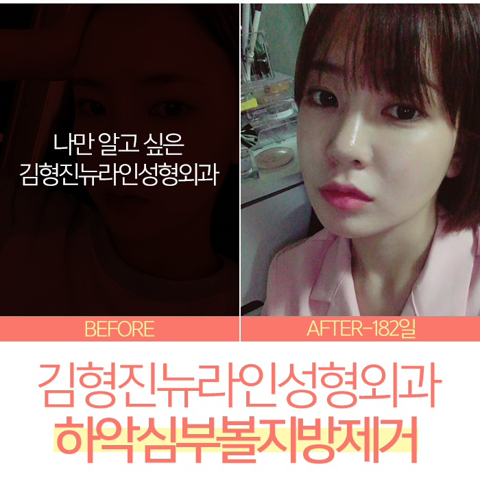 하악심부볼지방제거 어디다? 김형진뉴라인성형외과다! 관련 이미지 1