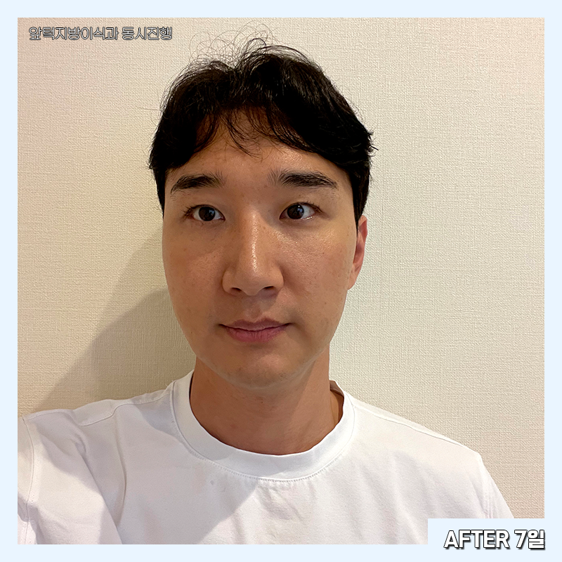 남자심부볼제거 가능하냐구요? 당연하죠! 관련 이미지 3