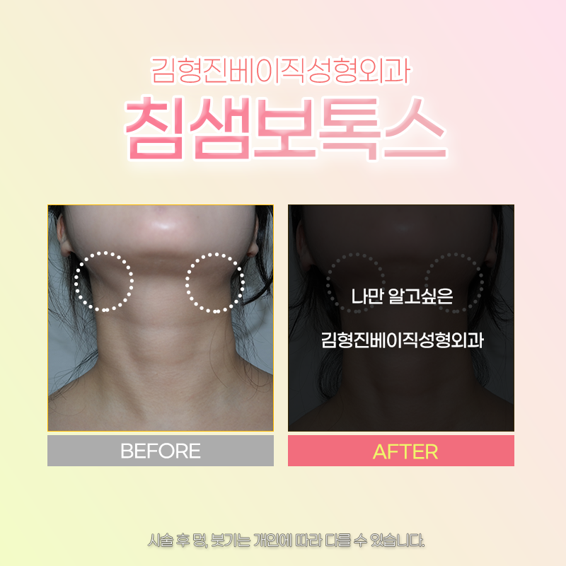 침샘치료 더 이상 미루지 마세요! 관련 이미지 5