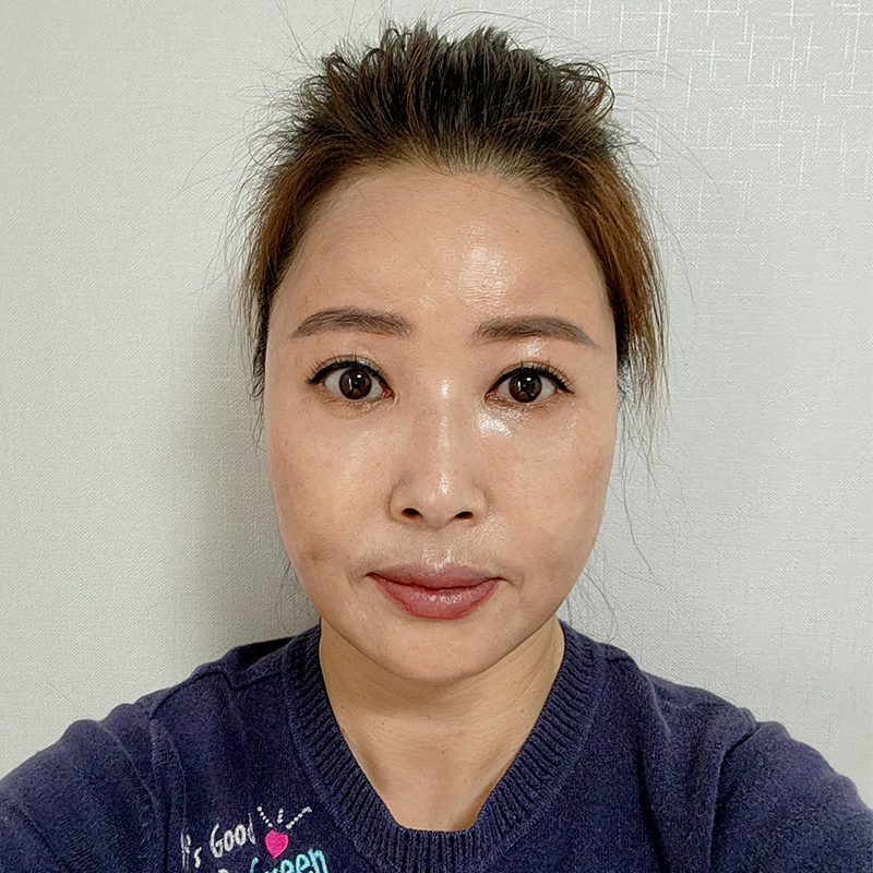 미니하안검재수술 발생 확률 적은 김형진베이직 관련 이미지 1