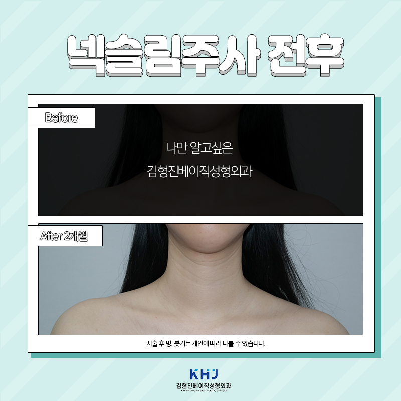 넥슬림주사전후 궁금하셨다면 보고 가세요! 관련 이미지 4