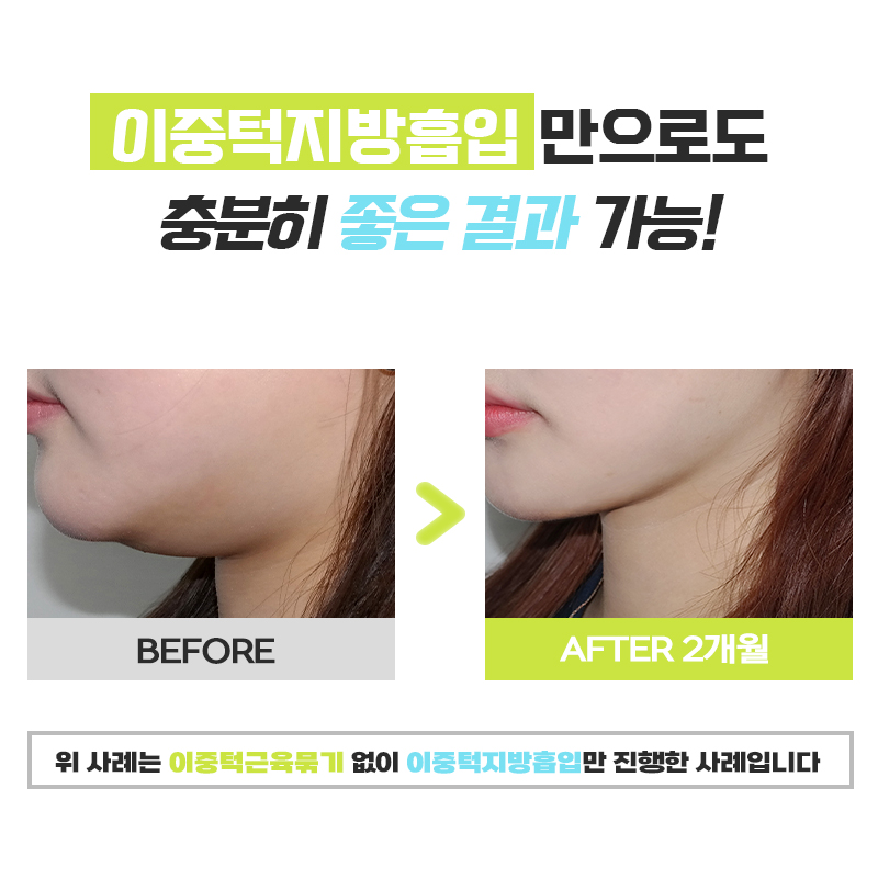 시술로 해결이 안 되는 턱살빼는법 관련 이미지 6
