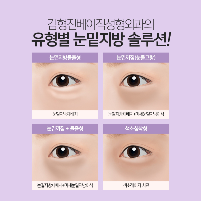 연예인눈밑지방재배치 이런 거구나 관련 이미지 5