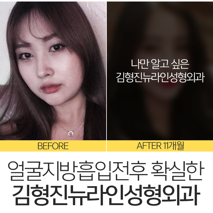 얼굴지방흡입전후 제대로 보려면 관련 이미지 8
