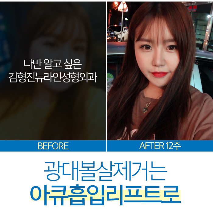 광대볼살제거 절대 어렵지 않아요 관련 이미지 5