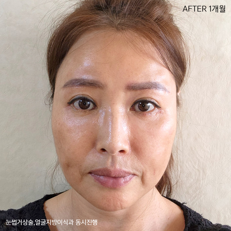 미니하안검회복과정 한 눈에 확인! 관련 이미지 6