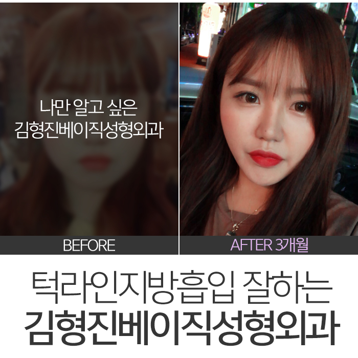 턱라인지방흡입 부담 없는 가격이죠 관련 이미지 3
