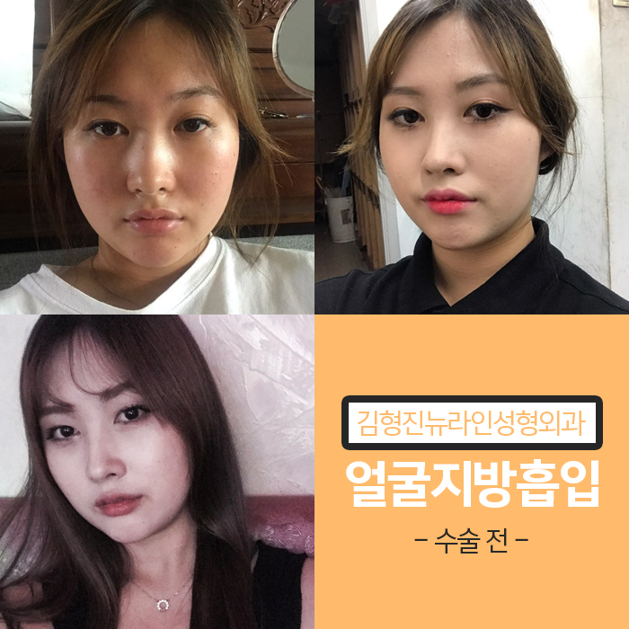 얼굴전체지방흡입 리얼후기 공개 관련 이미지 2