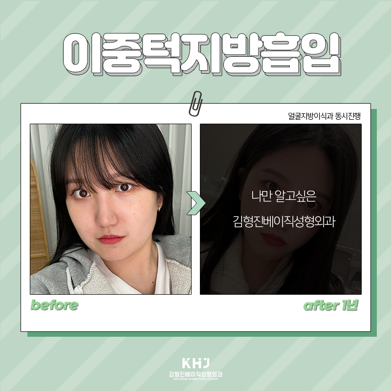 이중턱지방흡입후기 찾아보고 계셨죠? 관련 이미지 3