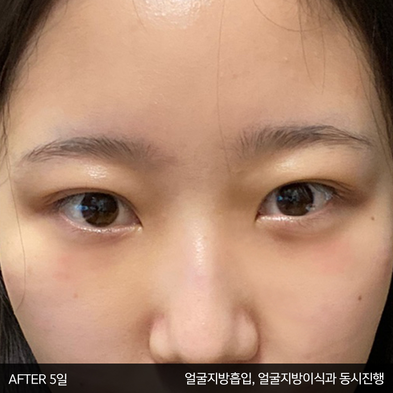 눈밑수술! 어떤건지 궁금하시죠? 관련 이미지 3