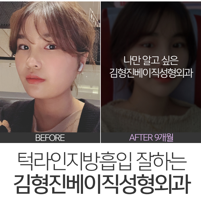 턱라인지방흡입 부담 없는 가격이죠 관련 이미지 6