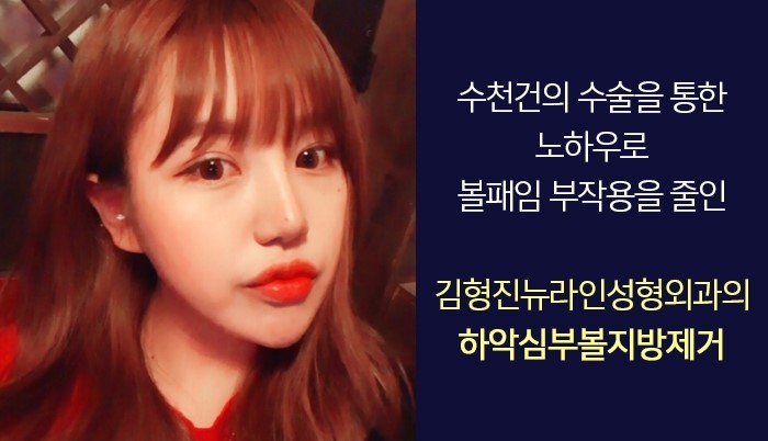 하악심부볼지방제거 수술로 부작용없는 김형진뉴라인성형외과 관련 이미지 6