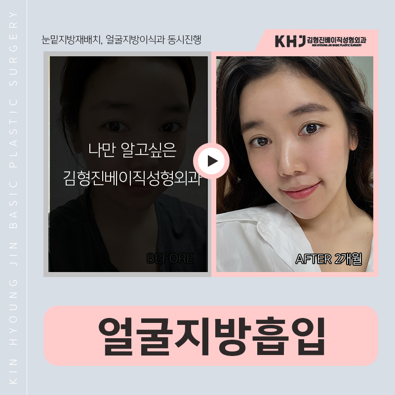 얼굴지방흡입후기 바로 여기에요! 관련 이미지 6