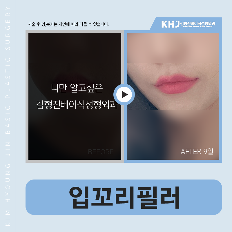 입꼬리필러모양 세심하게 잡아주는 곳 찾으신다면? 관련 이미지 6
