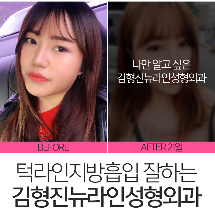 턱라인지방흡입 김형진원장이 체고야! 관련 이미지 8