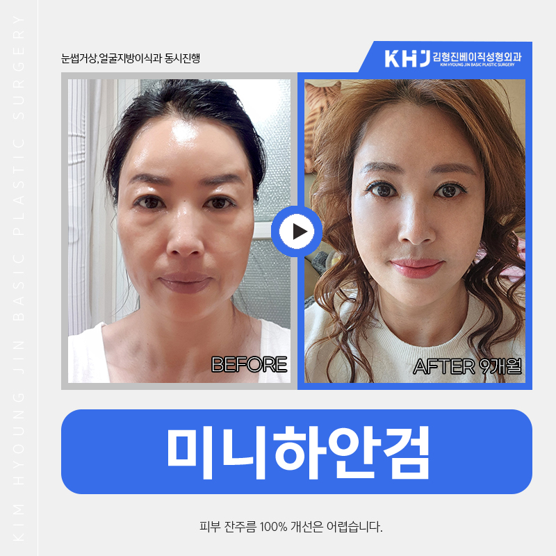중년수술, 미니하안검후기 보고 결정하세요! 관련 이미지 5