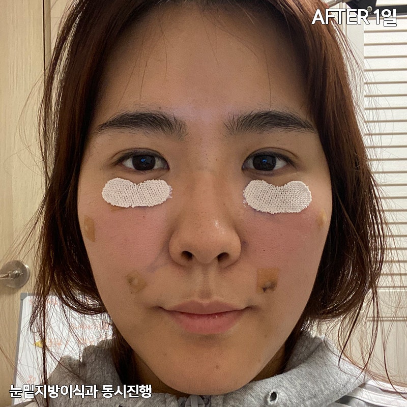 눈밑지방재배치유지력 하면 김형진베이직 관련 이미지 3