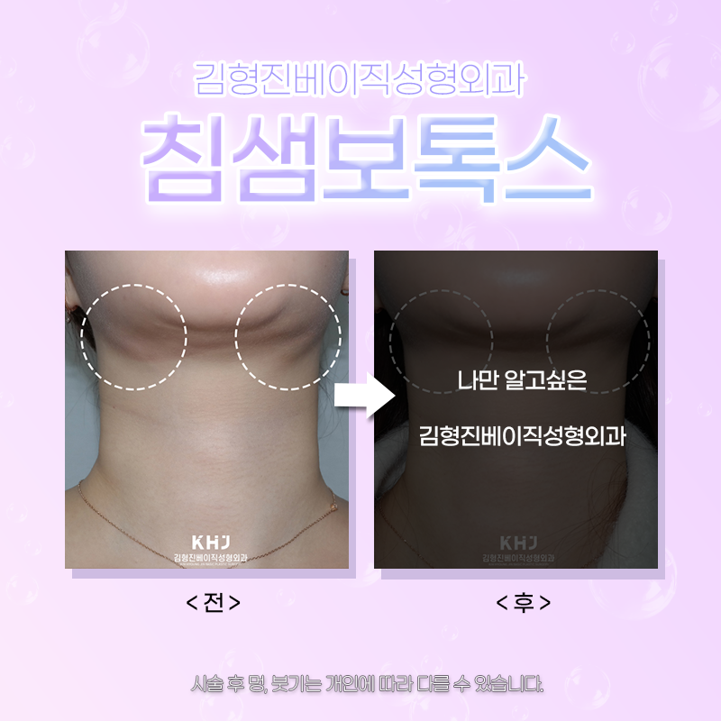 침샘비대증보톡스 효과 볼 수 있는 곳으로 가셔야죠! 관련 이미지 5