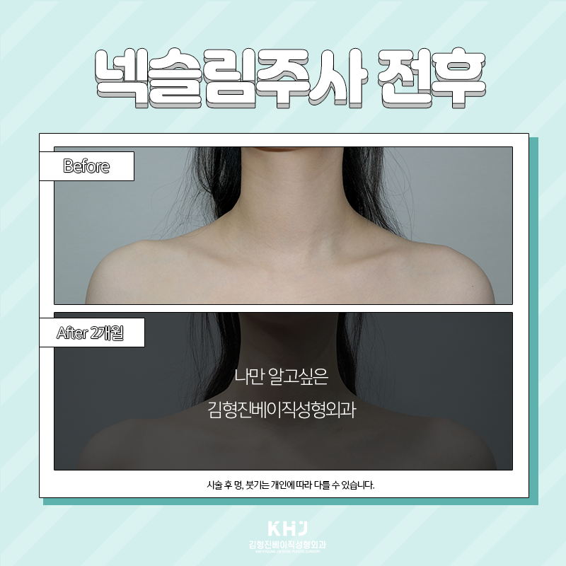 넥슬림주사전후 확인하고 가세요~! 관련 이미지 5