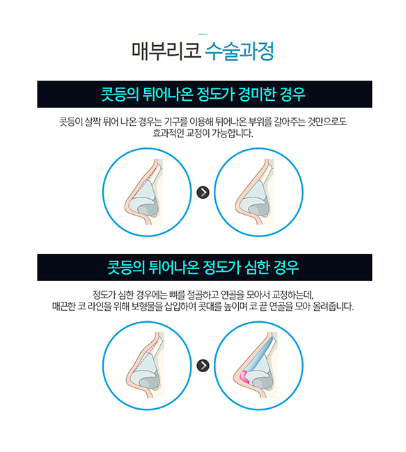 코성형종류 나에게 알맞은 것은~? 관련 이미지 4