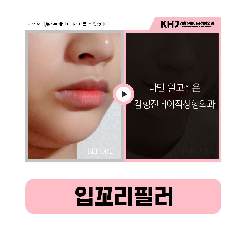 자연스럽게 올라간 미소, 입꼬리올리는시술로 완성해요 관련 이미지 5